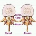 تنگی کانال ستون فقرات